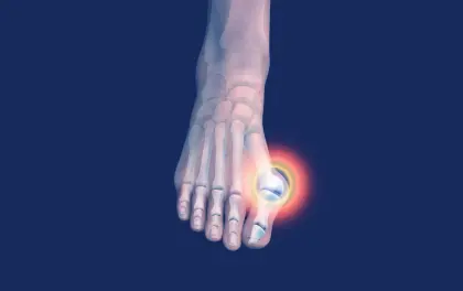 Bluegrass Orthopaedics for Bunion Treatment