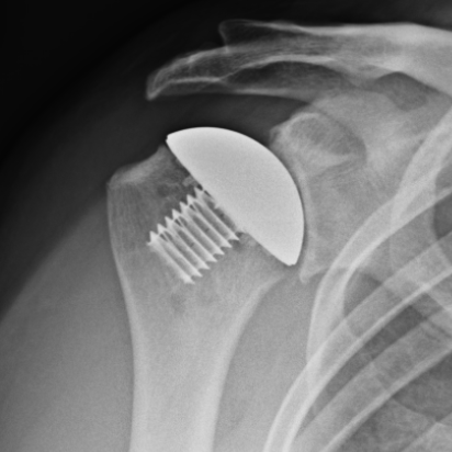 Comeback Champion: David Hall