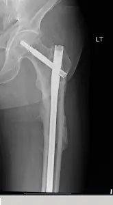 Post-Operative X-Ray