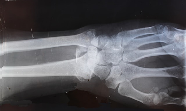 BGO Distal Radius Fracture