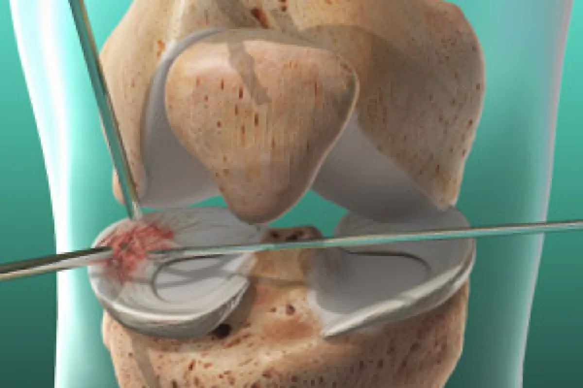 Arthroscopic Knee Surgery BGO